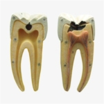 GD/B10005-2 Dental Caries Model