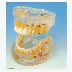 GD/B10011 Transparent Dental Pathology Model